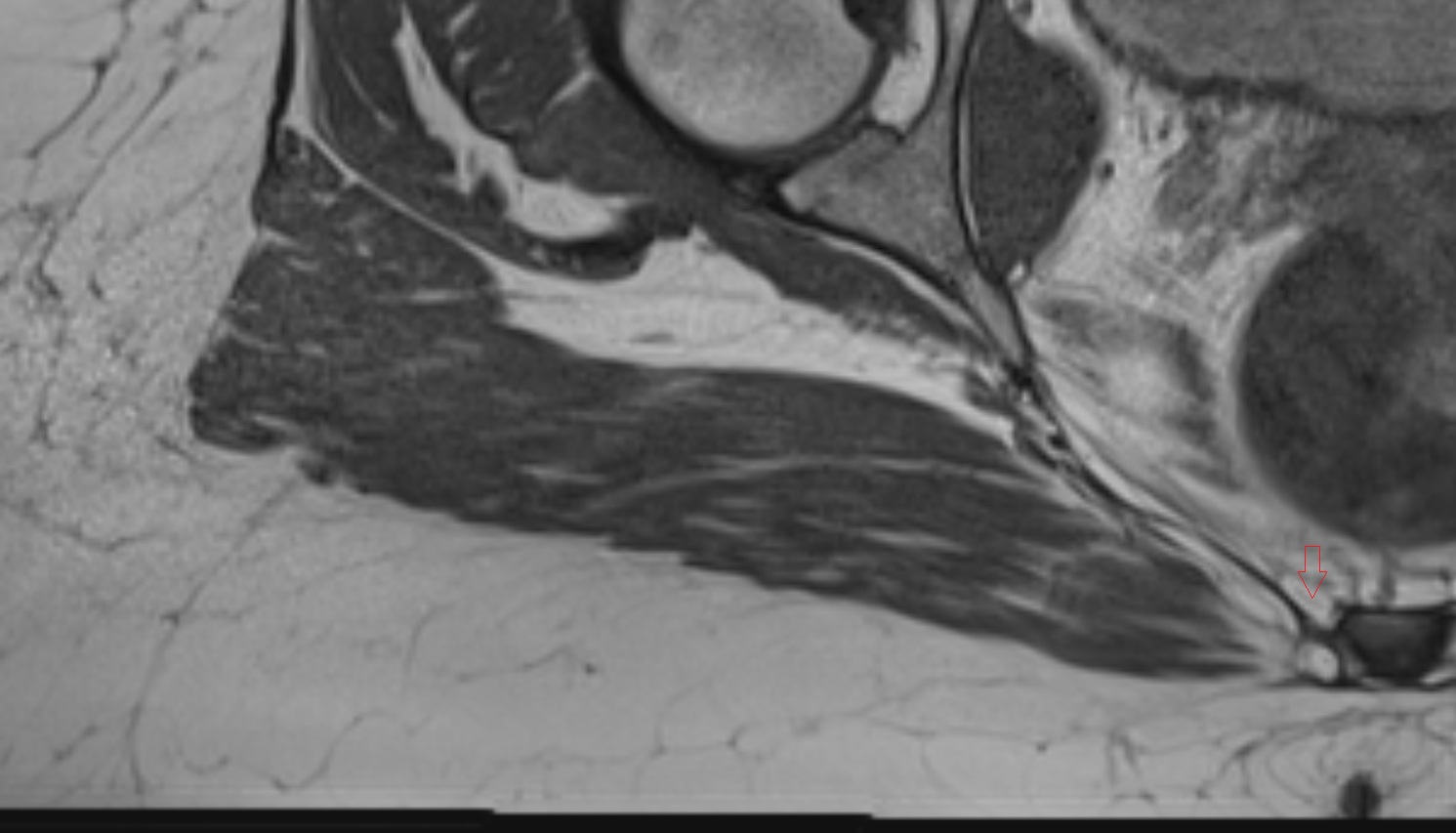 Coccygeal nerve  MRI  axial  anatomy  image-img-00000-00000