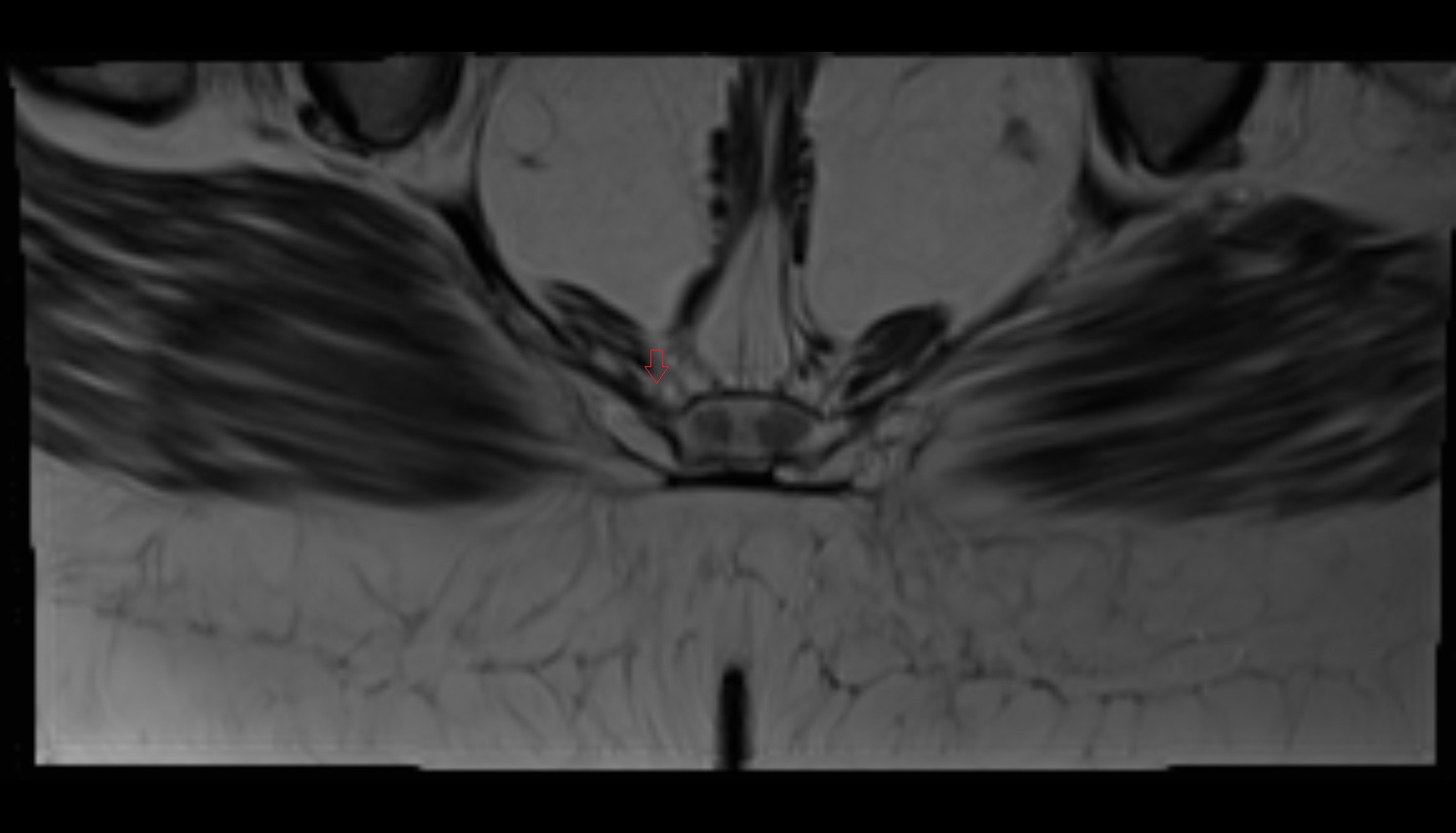 Coccygeal nerve  MRI  axial  anatomy  image-img-00000-00000_00001