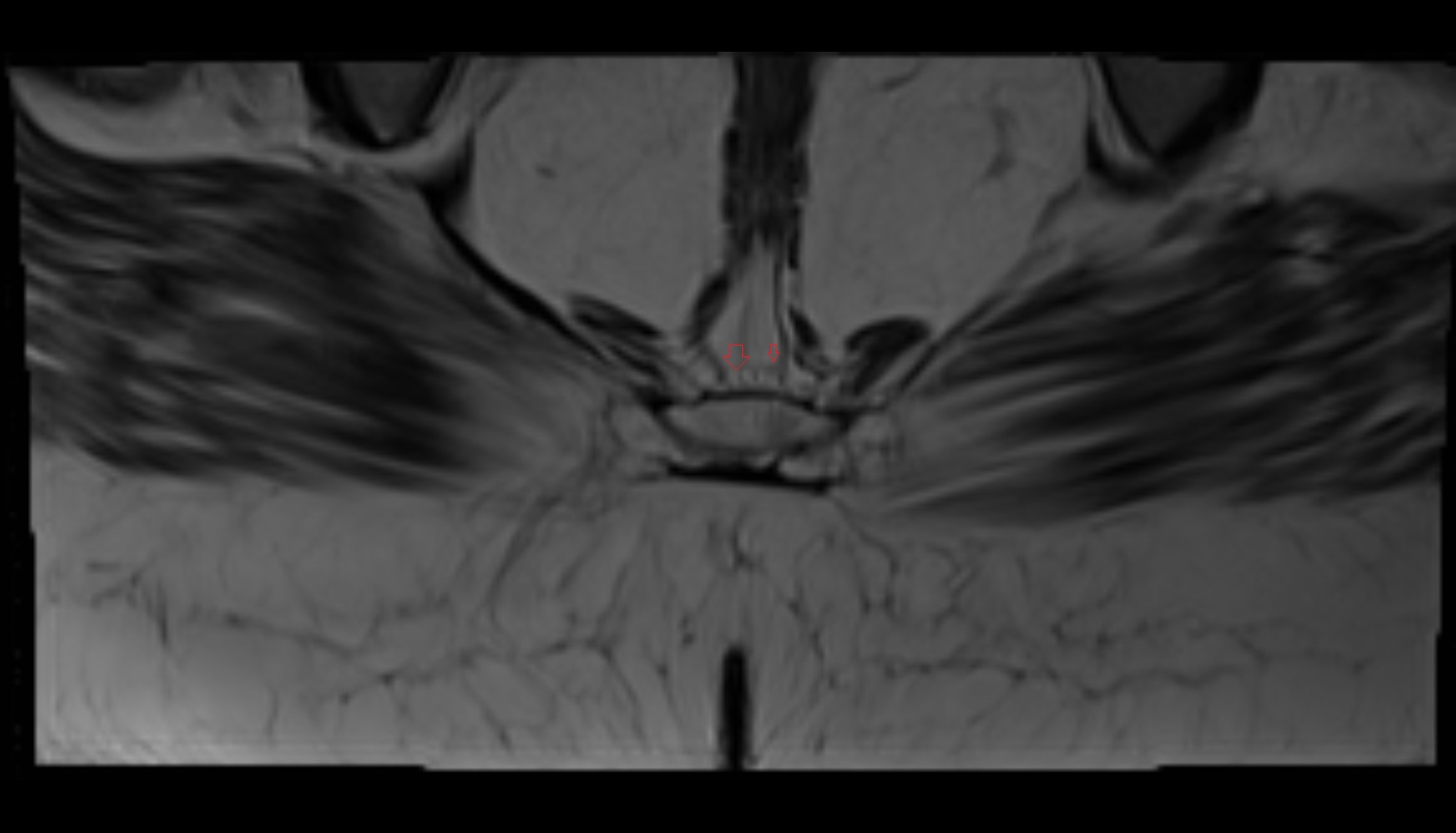 Coccygeal plexus  MRI  axial  anatomy  image-img-00000-00000