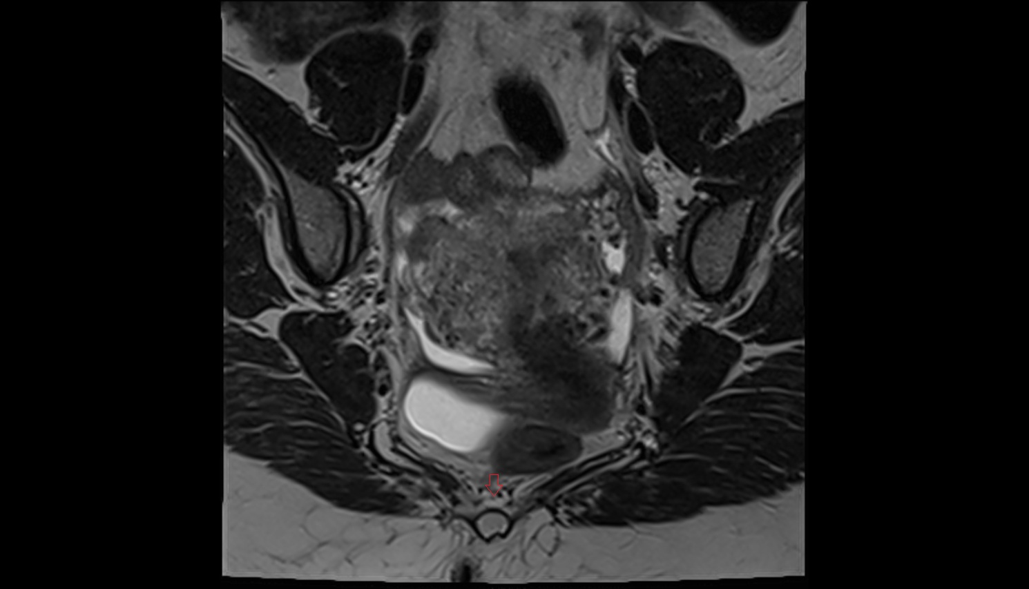 Coccygeal plexus  MRI coronal  anatomy  image-img-00000-00000