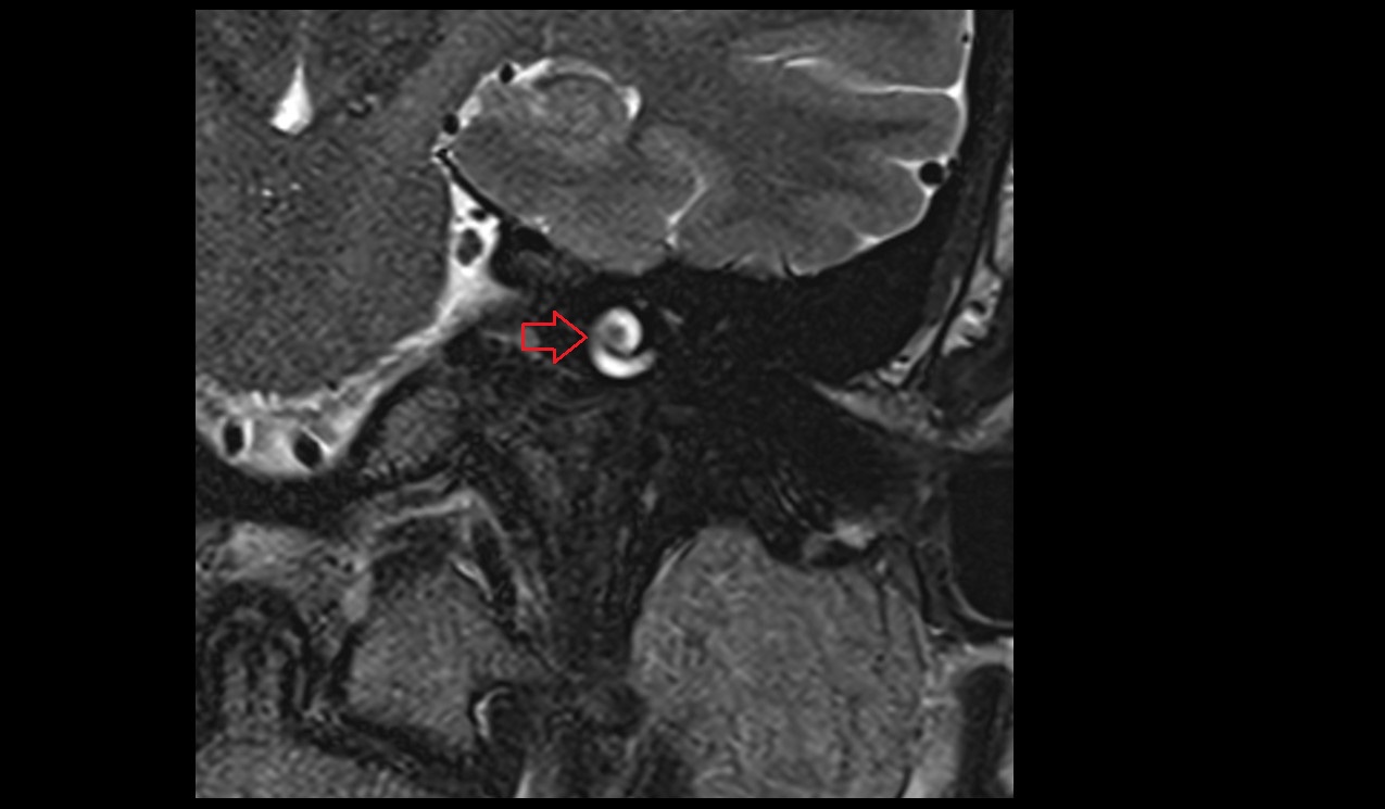 Cochlea MRI 3T coronal image