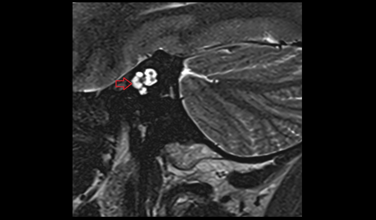 Cochlea MRI 3T sagittal image