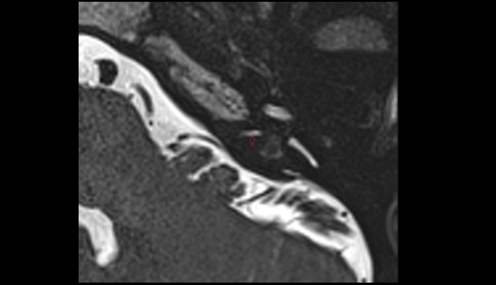 Cochlear canaliculus MRI axial image