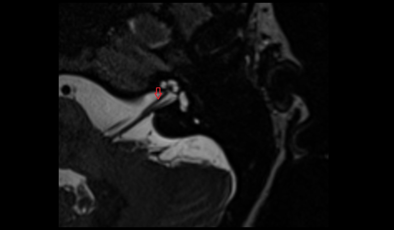 Cochlear nerve MRI 3T axial image 1