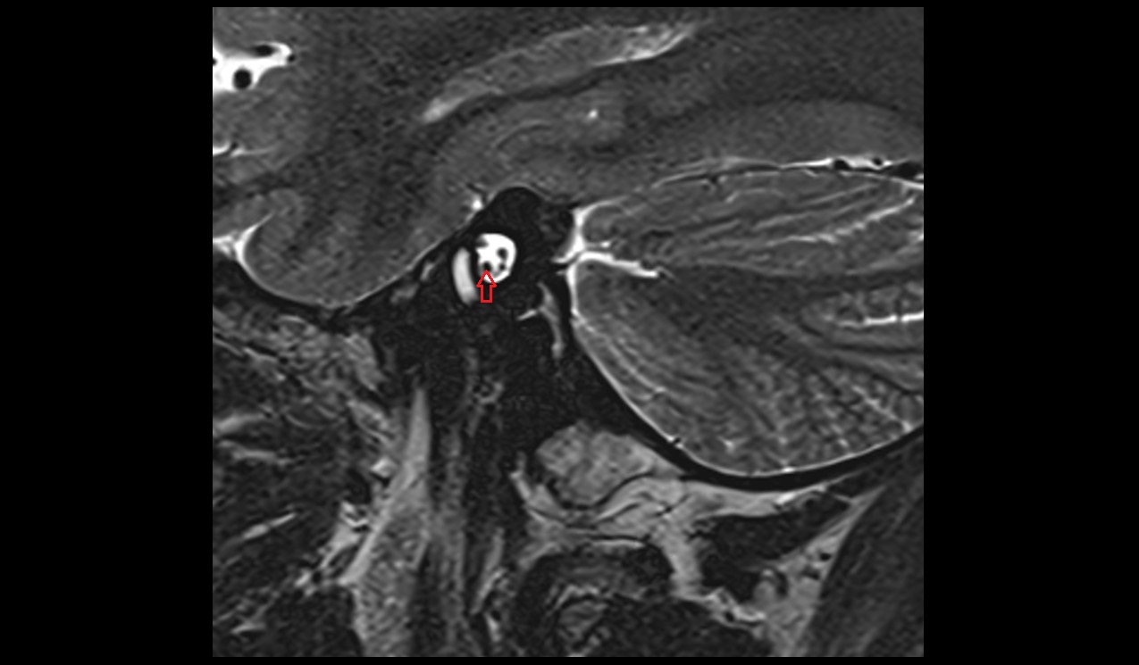 Cochlear nerve MRI 3Tsagittal  image 1
