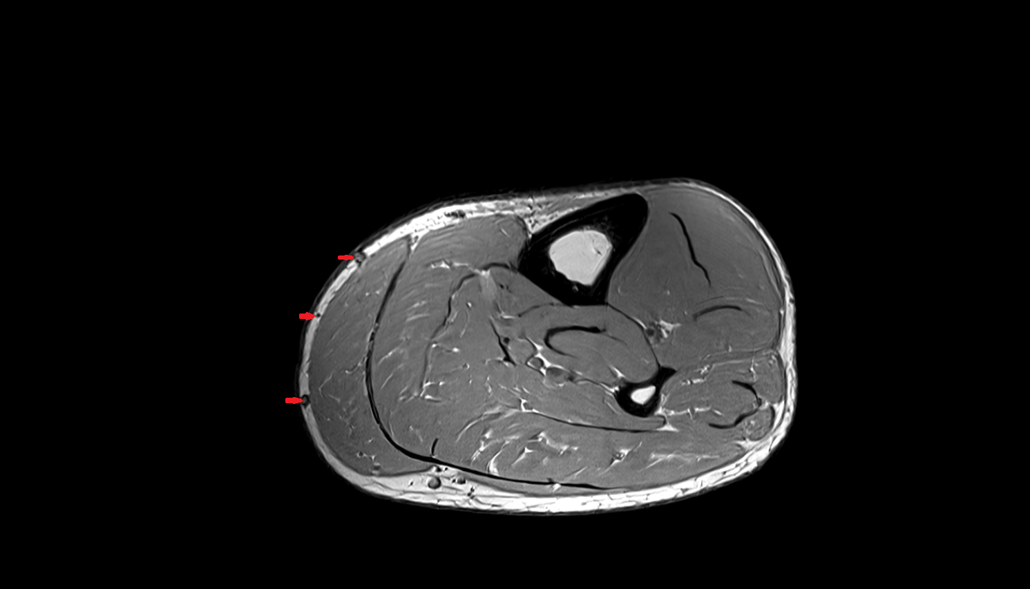 Cockett’s perforator veins axial cross sectional anatomy 3T MRI AI enhanced radiology image-img-00000-00000_00001