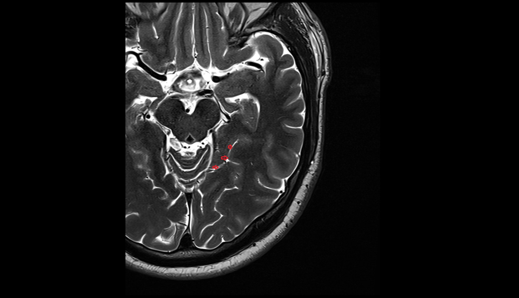 Collateral sulcus mri 3t axial image