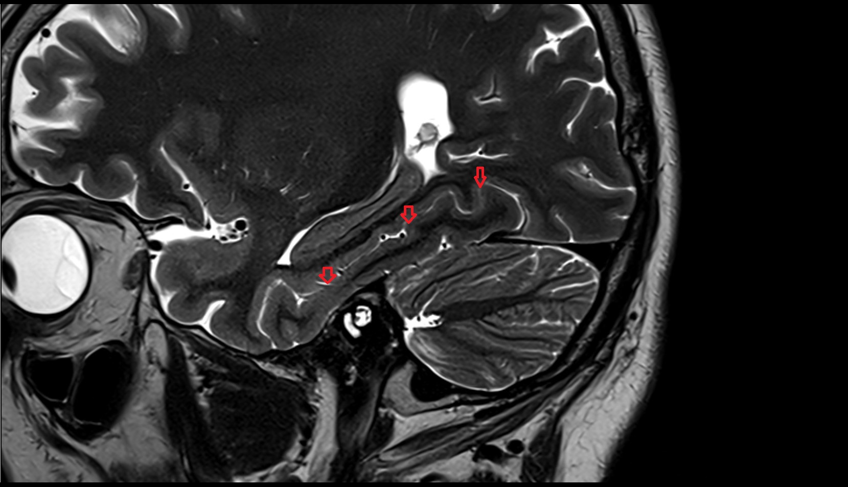 Collateral sulcus mri 3t sagittal image