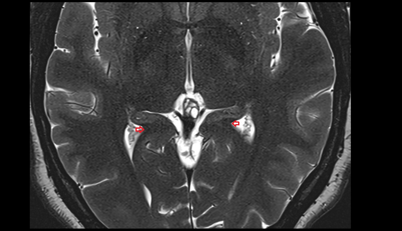 Collateral trigone mri axial image