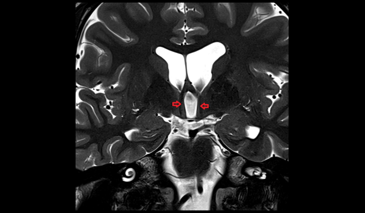 Column of fornix mri 3t coronal image