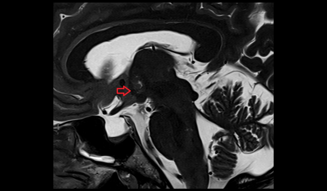 Column of fornix mri 3t  sagittal image