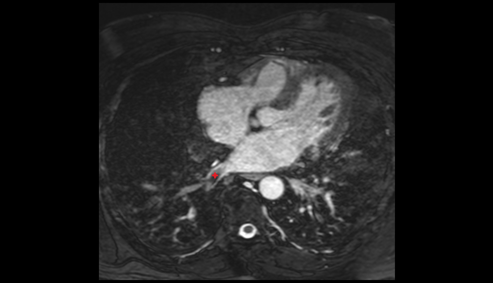 Common basal vein of right lung mri axial image