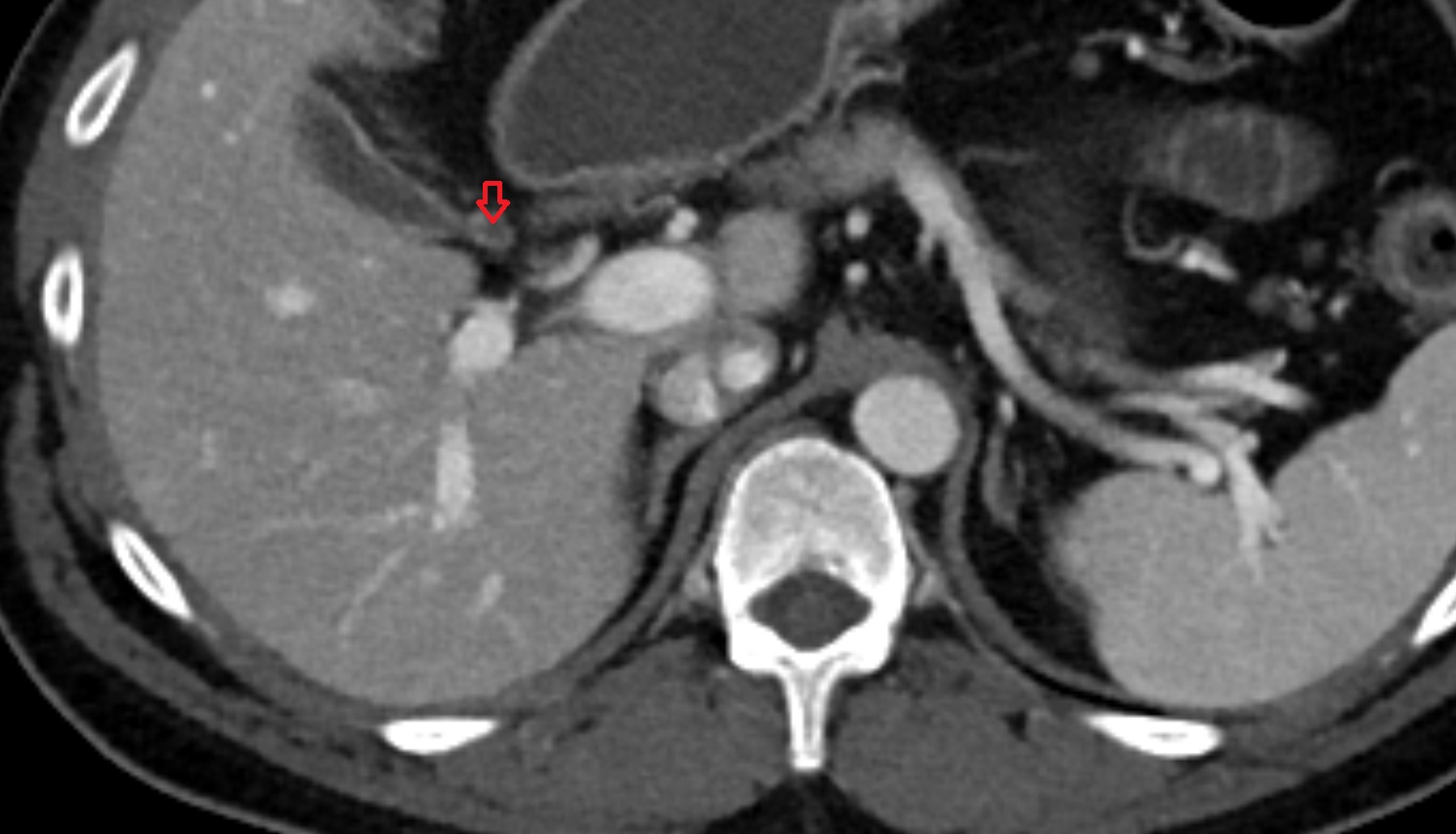 Common bile duct ct axial   anatomy  image-img-00000-00000