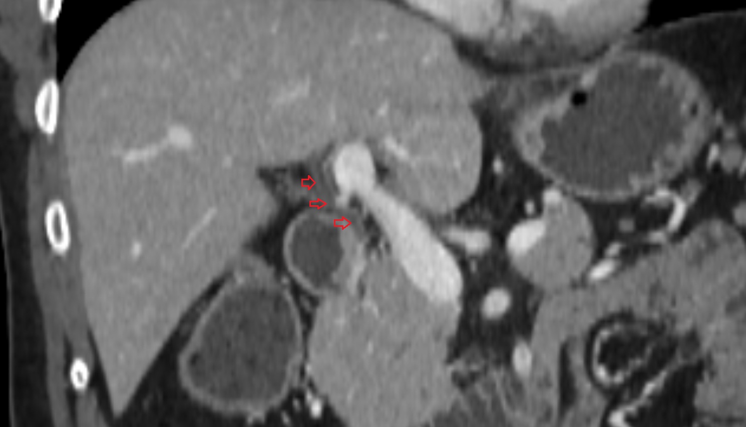 Common bile duct ct coronal   anatomy  image-img-00000-00000