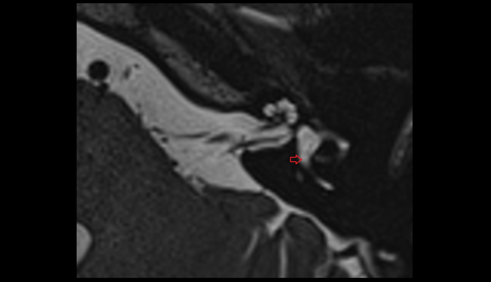 Common bony crus mri axial image 1