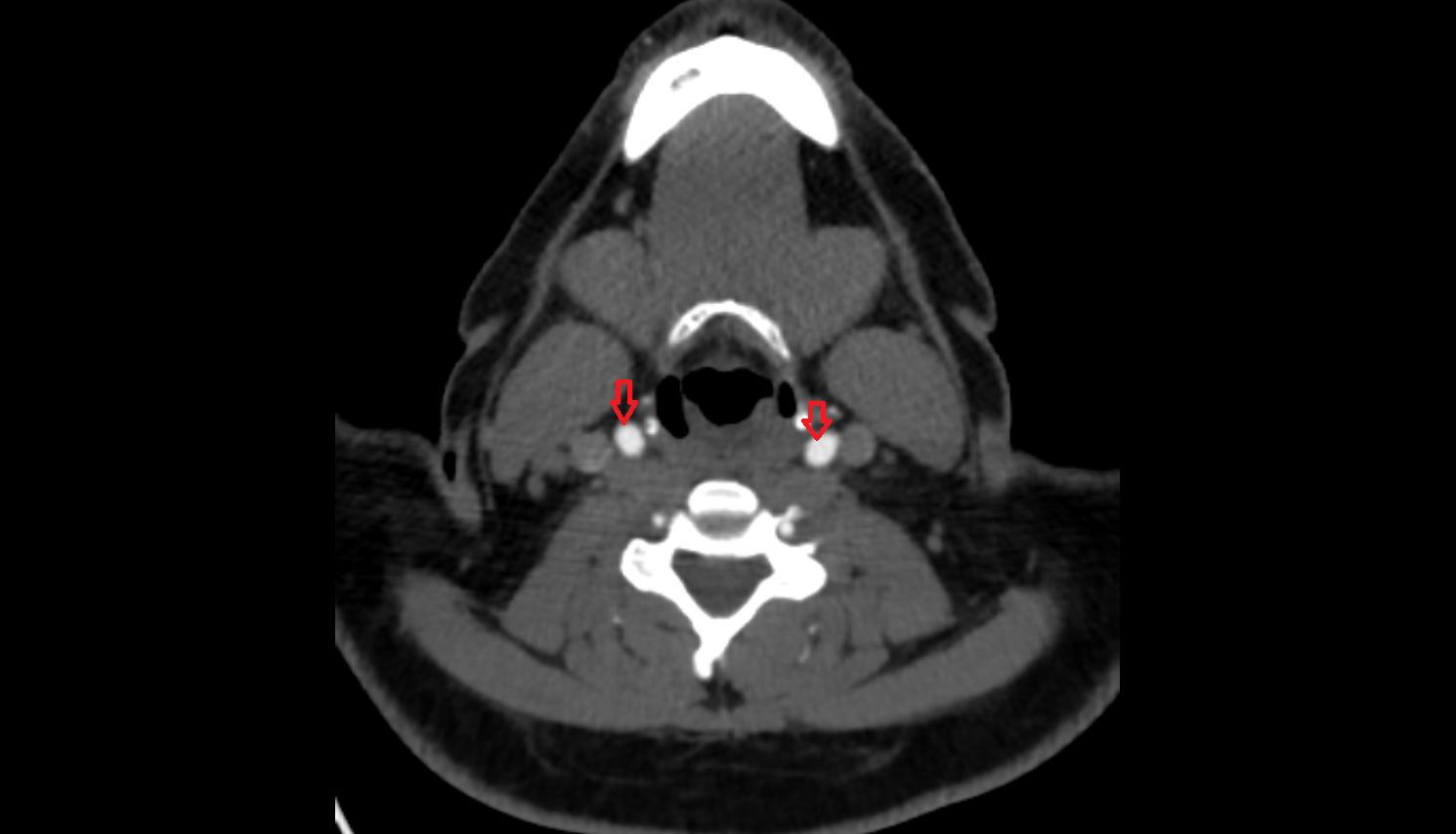 Common carotid artery CT axial  image-img-00000-00000