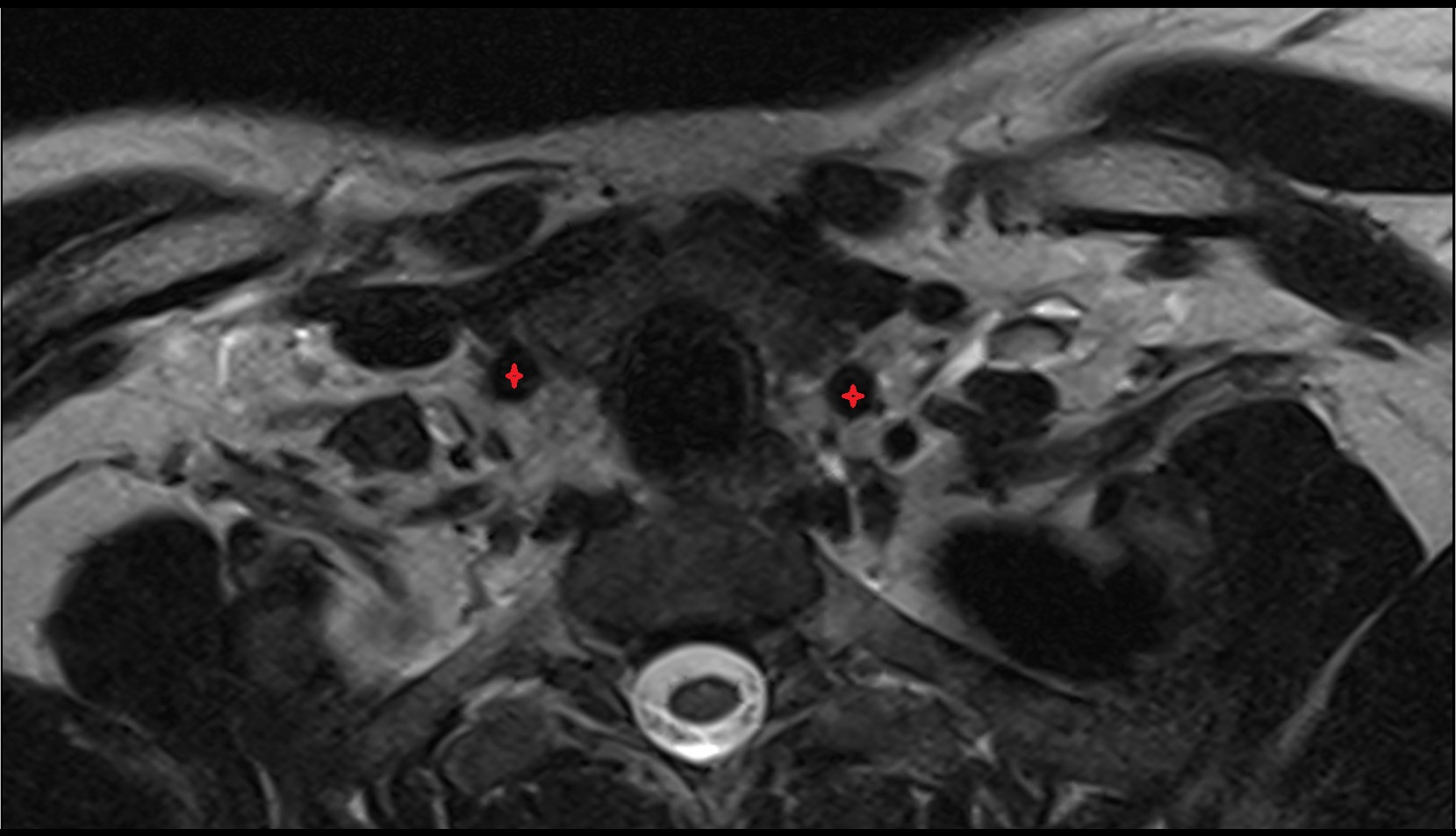 Common carotid artery axial t2