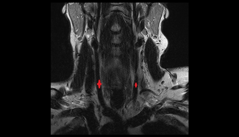 Common carotid artery coronal t2 image