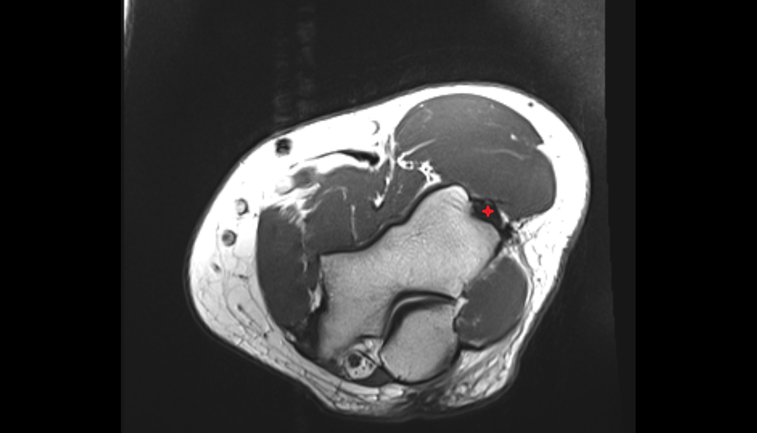 Common extensor tendon axial cross sectional anatomy 3T MRI AI enhanced radiology image -img-00000-00000