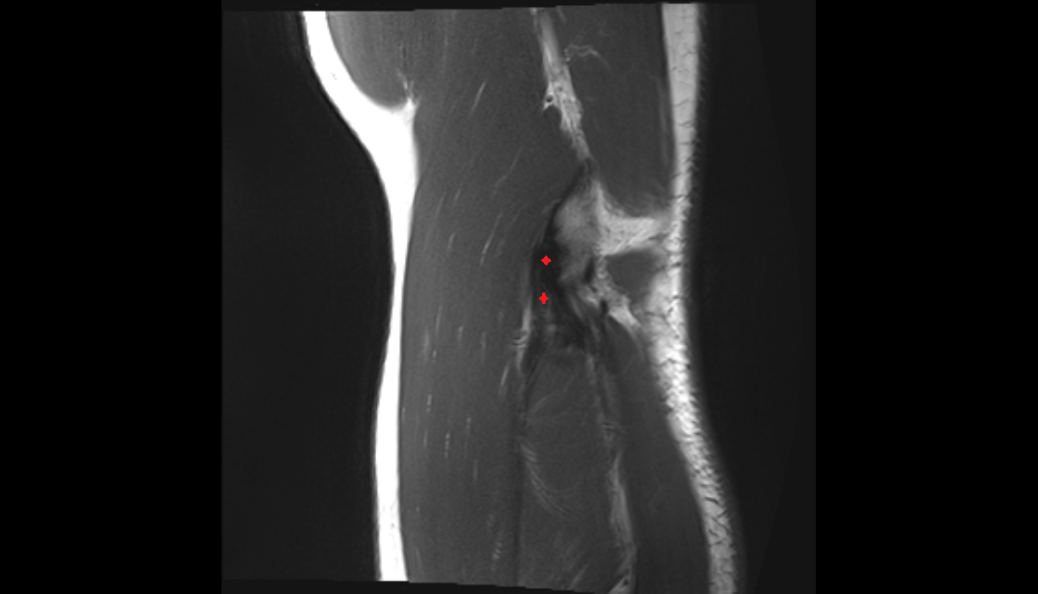 Common extensor tendon axial cross sectional anatomy 3T MRI AI enhanced radiology image -img-00000-00000_00002