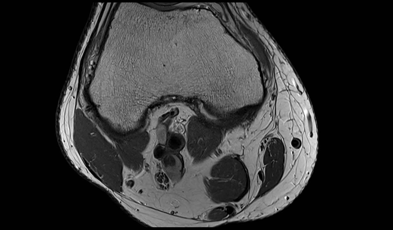 Common fibular nerve