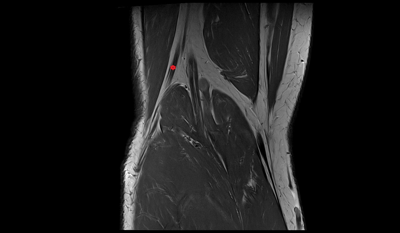 Common fibular nerve mri image