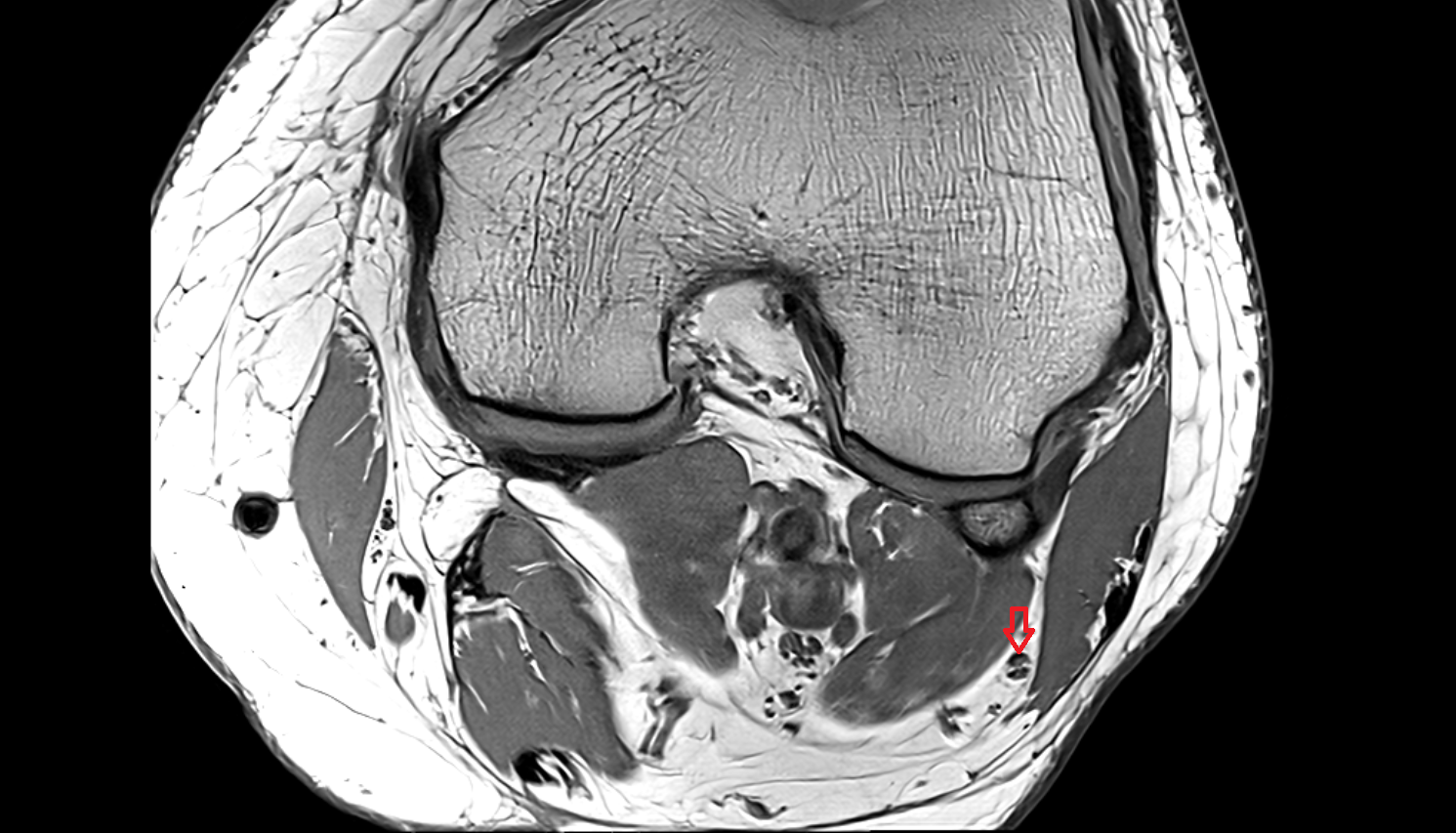 Common fibular (peroneal) nerve  axial  cross sectional anatomy 3T MRI AI enhanced  radiology  anatomy image-img-00000-00000_00001