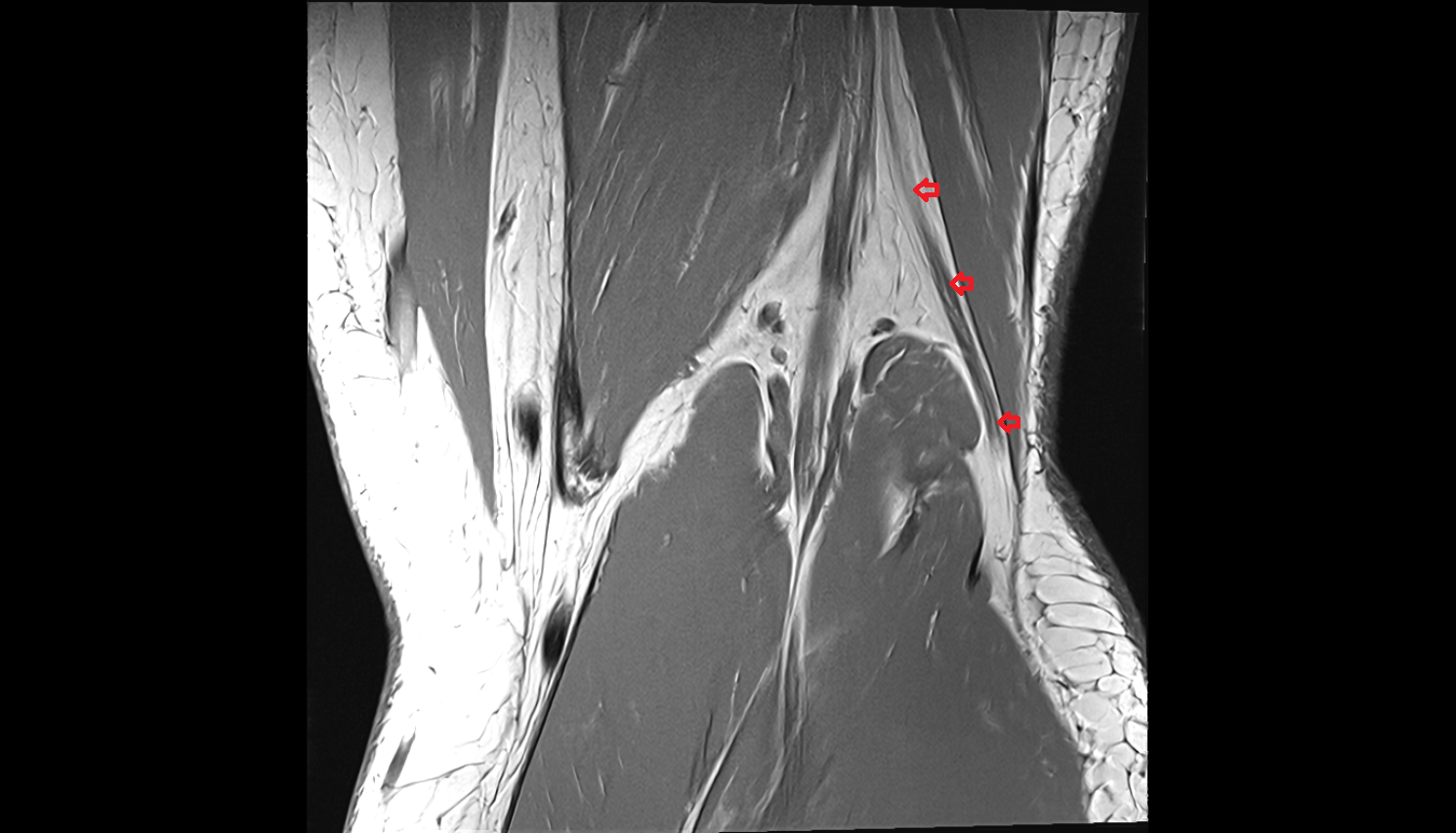 Common fibular (peroneal) nerve coronal  cross sectional anatomy 3T MRI AI enhanced  radiology  anatomy image-img-00000-00000