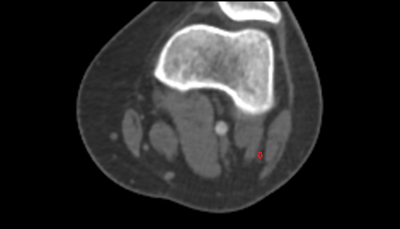 Common fibular (peroneal) nerve ct 1