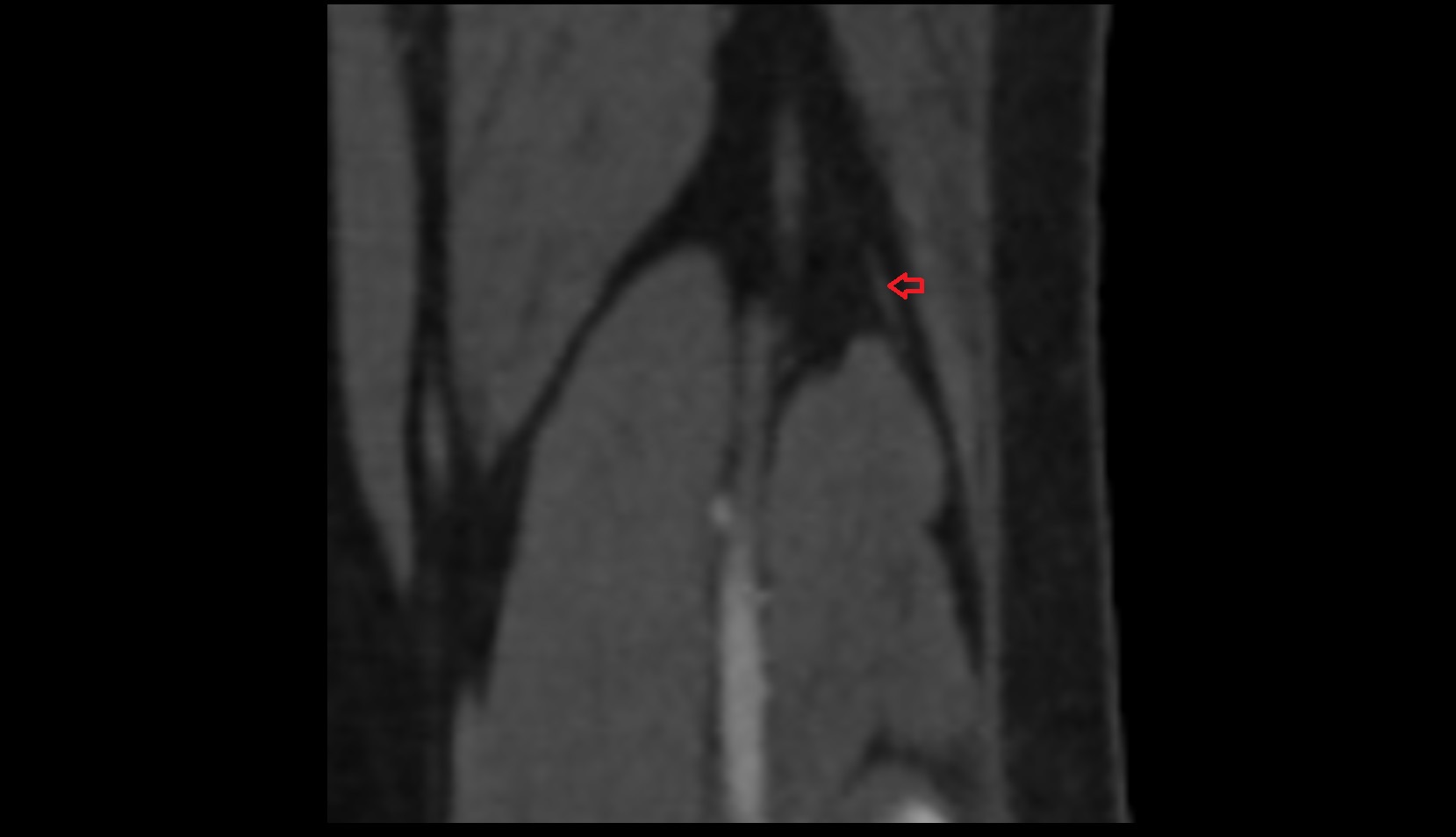 Common fibular (peroneal) nerve ct coronal