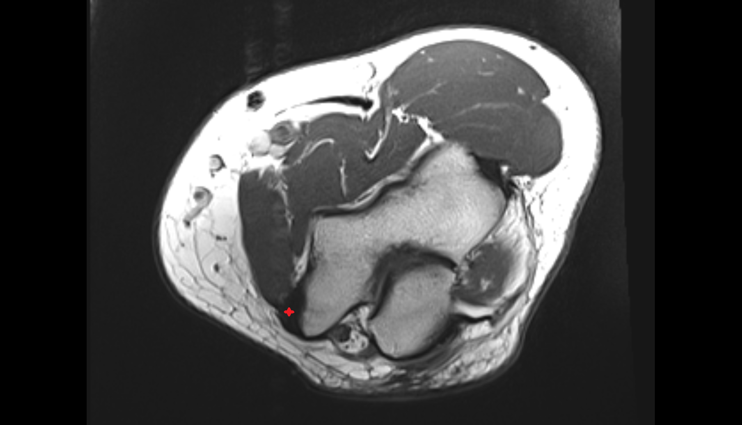 Common flexor tendon axial cross sectional anatomy 3T MRI AI enhanced radiology image -img-00000-00000