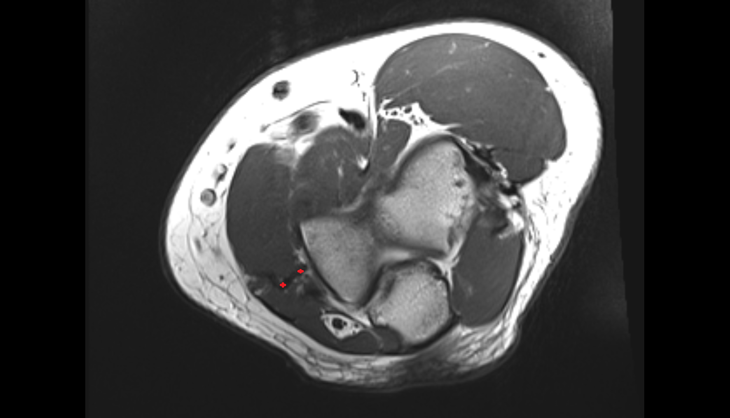 Common flexor tendon axial cross sectional anatomy 3T MRI AI enhanced radiology image -img-00000-00000_00001
