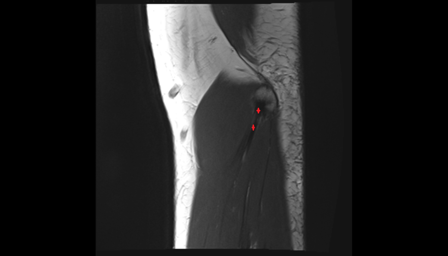 Common flexor tendon axial cross sectional anatomy 3T MRI AI enhanced radiology image -img-00000-00000_00003
