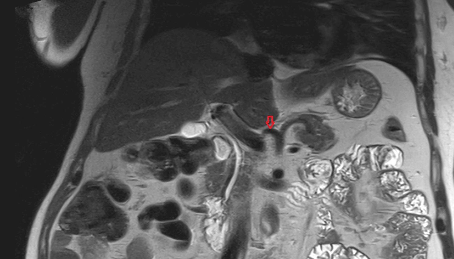 Common hepatic artery MRI CORONAL anatomy  image -img-00000-00000