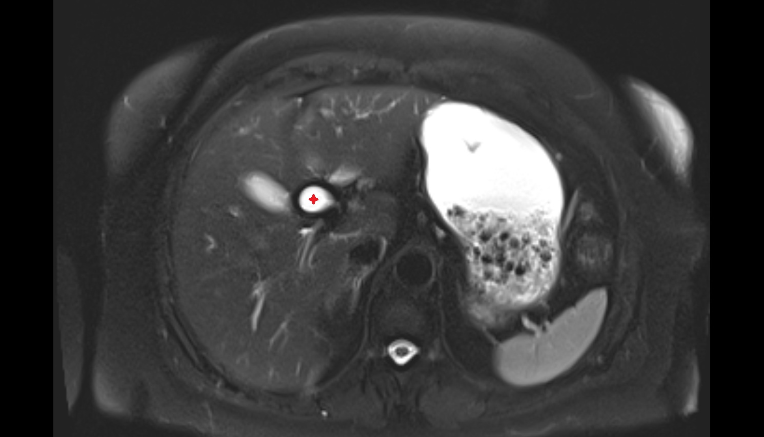 Common hepatic duct  mri  axial   anatomy  image-img-00000-00000