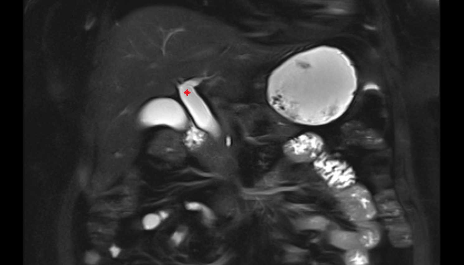 Common hepatic duct  mri  coornal   anatomy  image-img-00000-00000