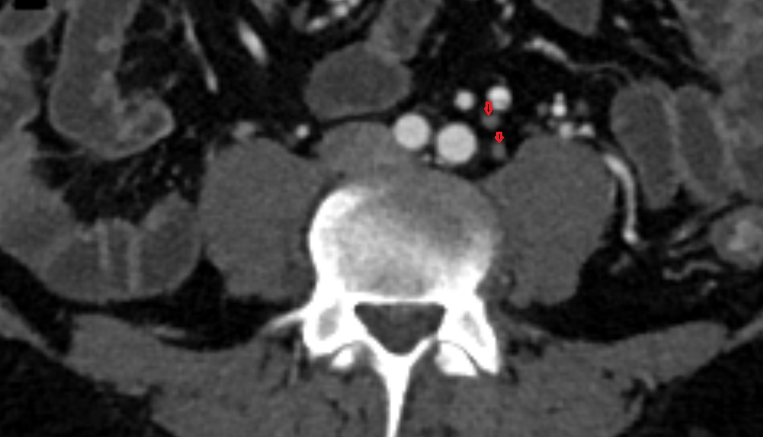 Common iliac lymph nodes  ct axial  anatomy  image-img-00000-00000