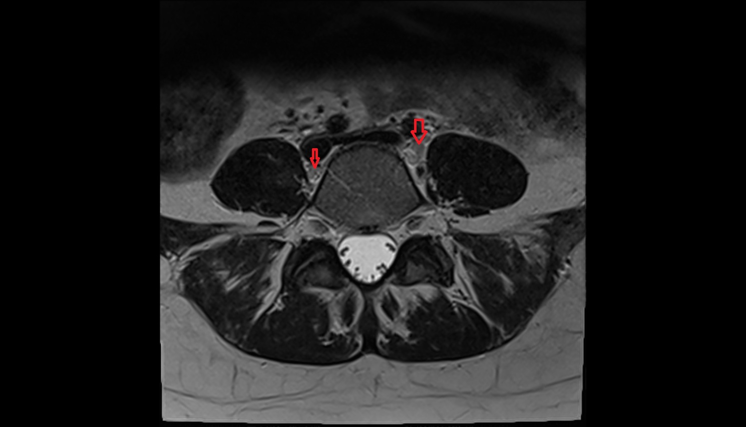 Common iliac lymph nodes  mri  axial  anatomy  image-img-00000-00000