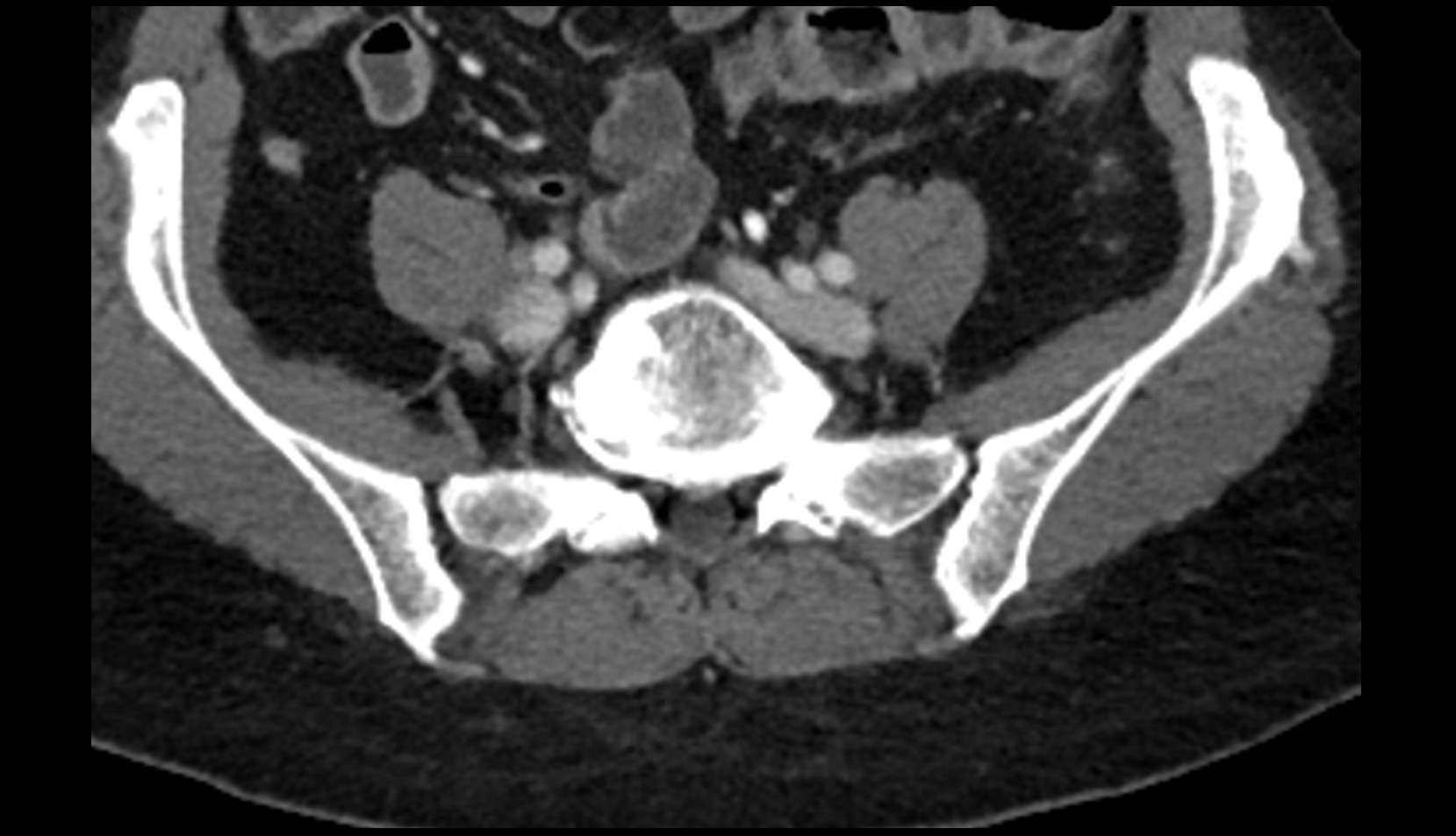 Common iliac vein CT axial image