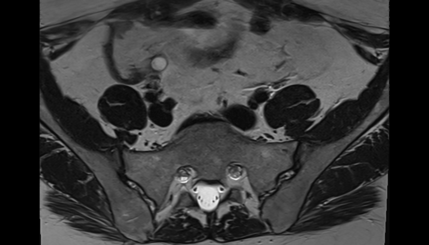 Common iliac vein  MRI  axial  anatomy  image-img-00000-00000