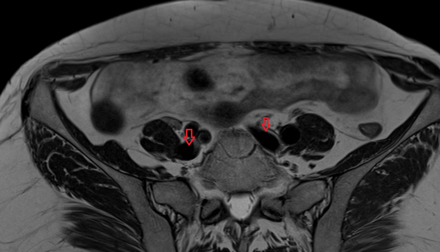 Common iliac vein  MRI  axial  anatomy  image-img-00000-00000_00001