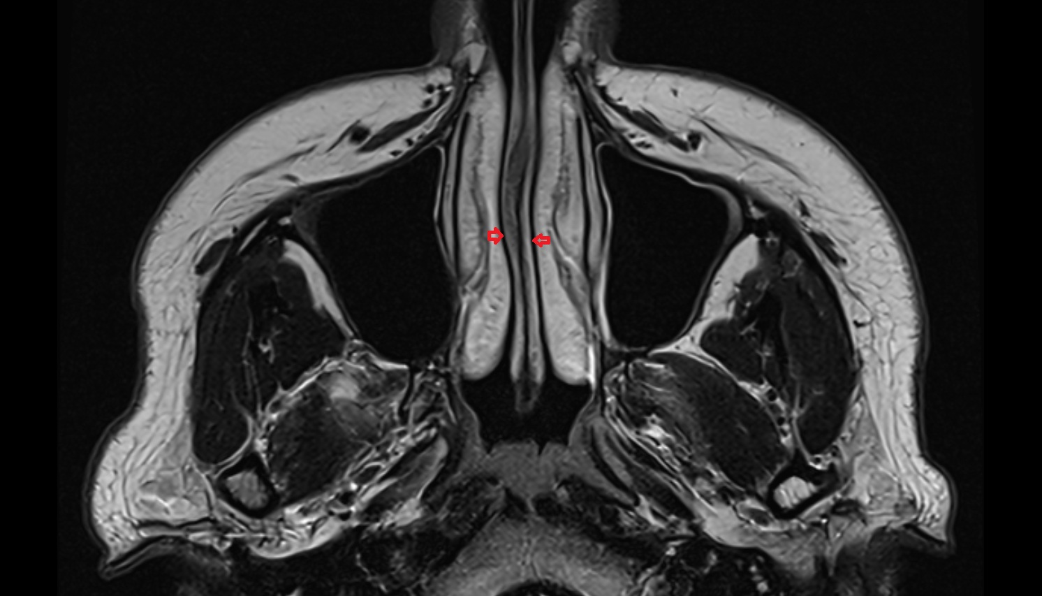Common nasal meatus mri axial image -img-00000-00000