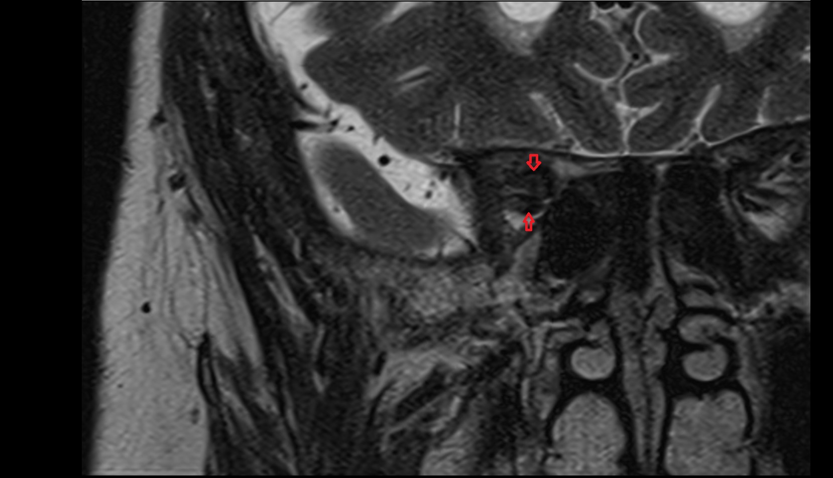 Common tendinous ring orbits mri image