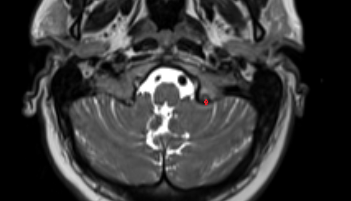 Condylar canal  mri axial image -img-00000-00000