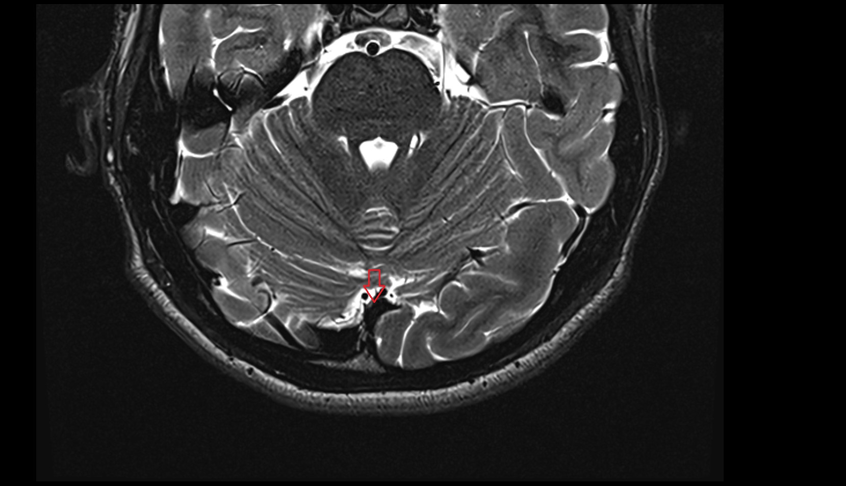 Confluence of sinuses MRI 3T axial image