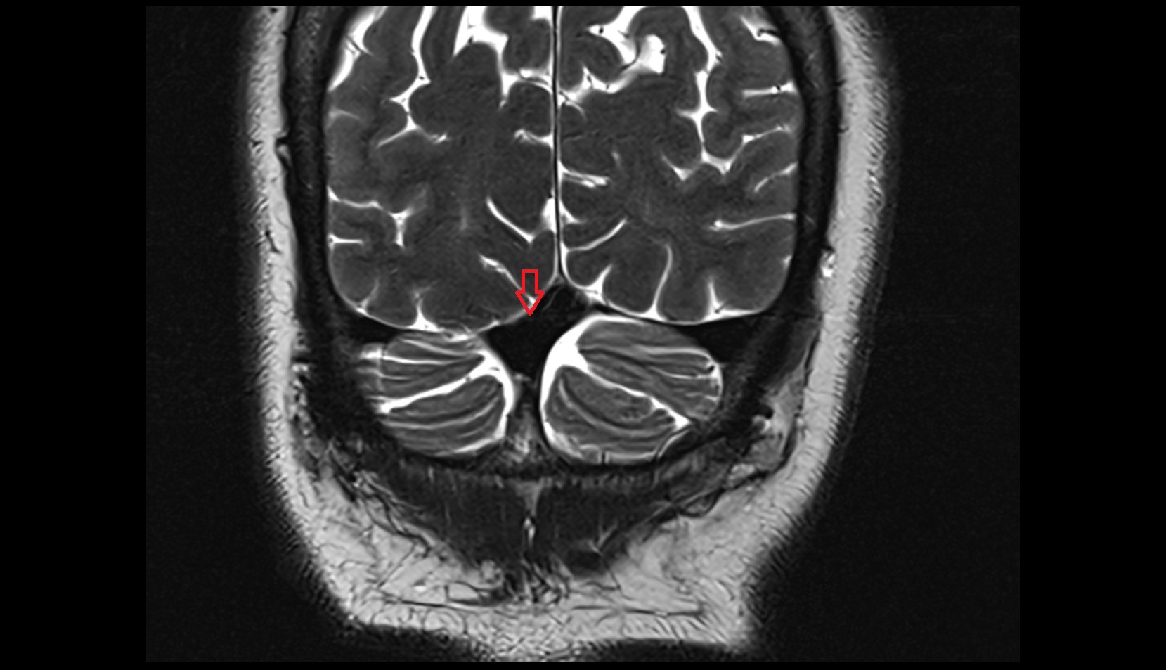 Confluence of sinuses MRI 3T coronal image