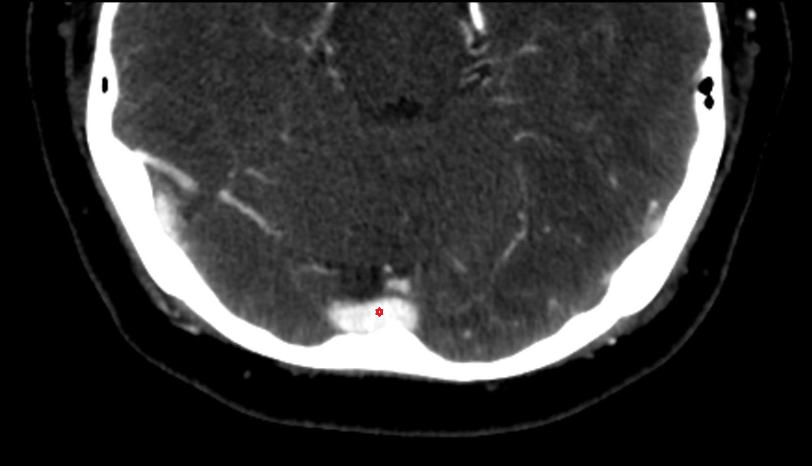 Confluence of sinuses ct