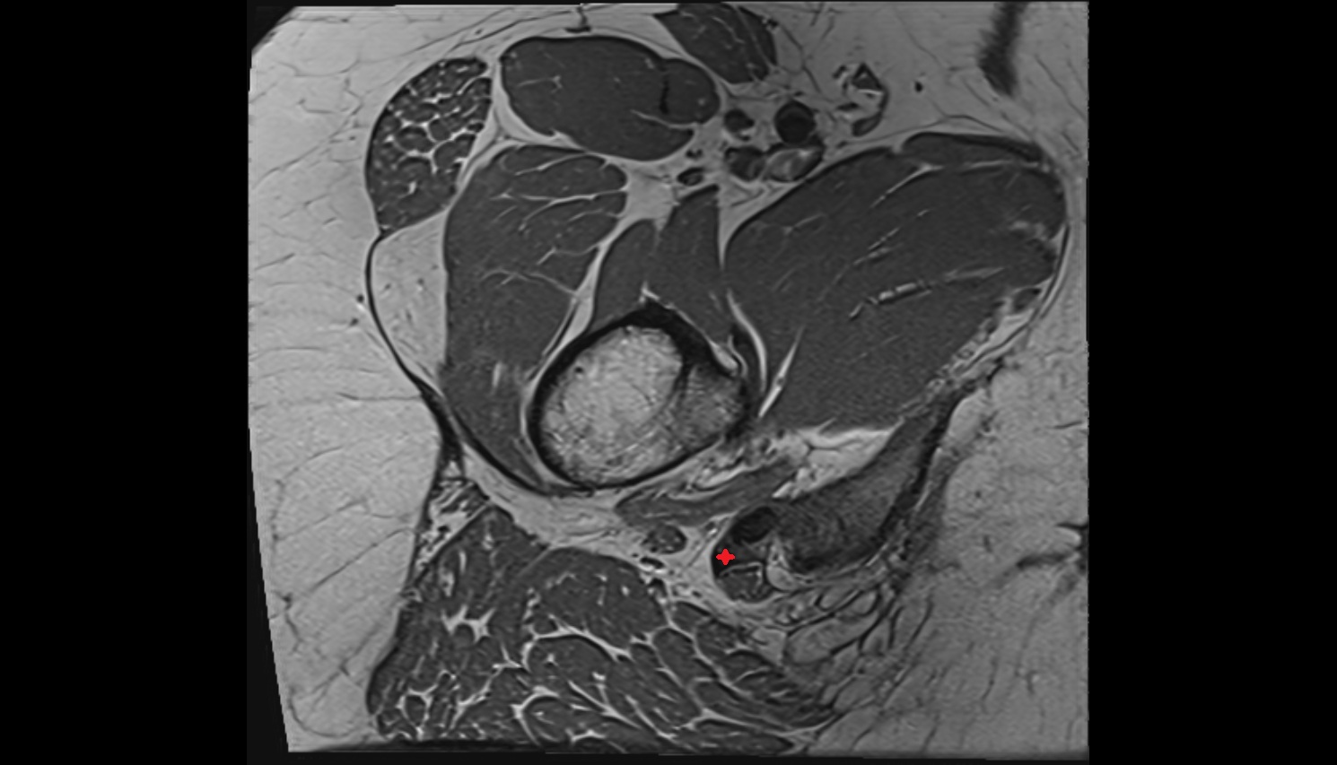 Conjoint tendon of biceps femoris & semitendinosus  MRI axial  anatomy image-img-00000-00000