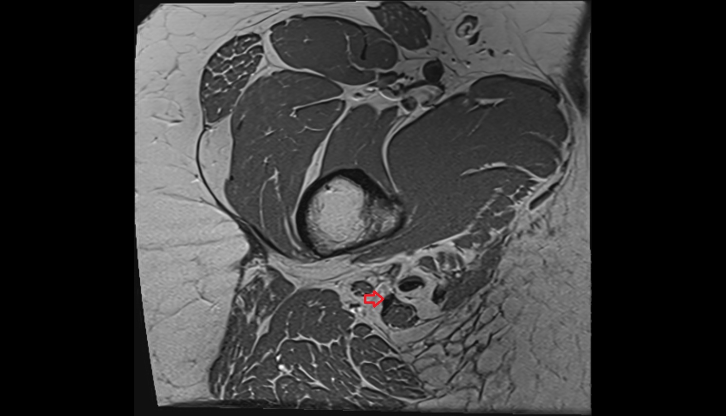 Conjoint tendon of biceps femoris & semitendinosus  MRI axial  anatomy image-img-00000-00000_00001