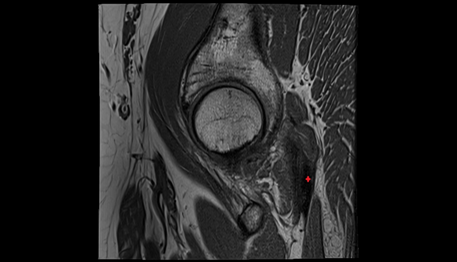 Conjoint tendon of biceps femoris & semitendinosus  MRI sag anatomy image-img-00000-00000